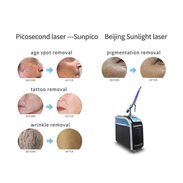 Skin Whitening Picosecond Laser Tattoo Removal Machine Easy Operation
