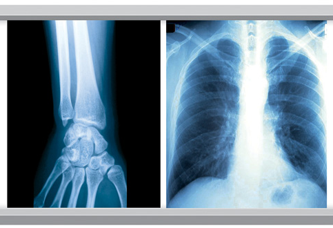 Blue White Base Medical X Ray Film 35x43CM 10x12 Inch X Ray Dry Film For Fuji Printer