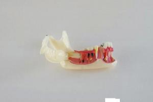 China Dental Half Lower Jaw Open Gum Bone Pathological Diseases on sale