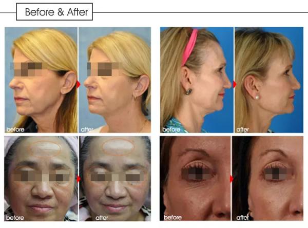 20000 Shots 12 Lines Facial Care HIFU Face Lifting Machine