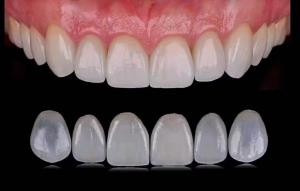  Tranlucent Emax Laminate Veneers / Porcelain Dental Veneers ISO Approved Manufactures