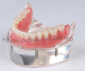 dental 4 impants hybrid denture combination lower arch model