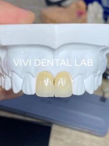 China Accurate Dental Lab Crowns Ivoclar Esthetic Zirconia Crowns Natural Looking on sale