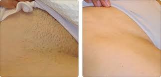 high performance diode laser hair removal price