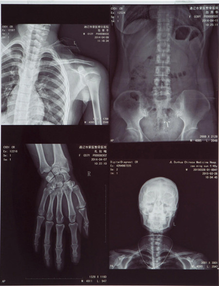 High-clarity Medical X Ray Film FUJI DIHT 14*17in Laser Dry Imaging Film