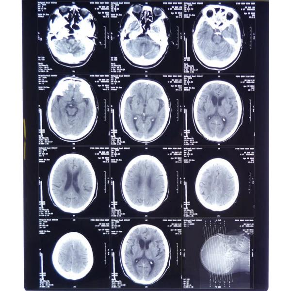 11X14 Inch Medical X-ray Film / Analogue Medical Film / Dry Film