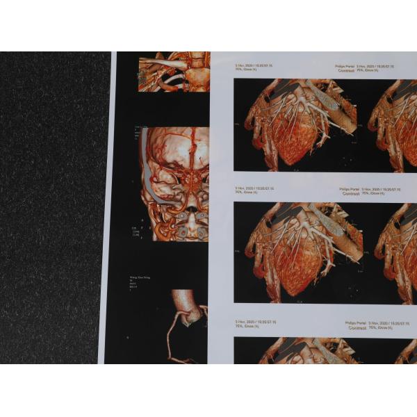 240gsm 180 Micron Medical Inkjet Film 3D CT Chest Film Environmental Friendly