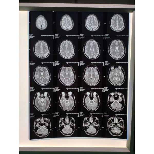 13X17'' White 180 Microns PET X Ray Film Sheets Transparency Film For Inkjet Printers